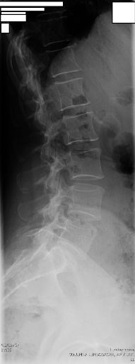 Lateral Lumbar Radiograph